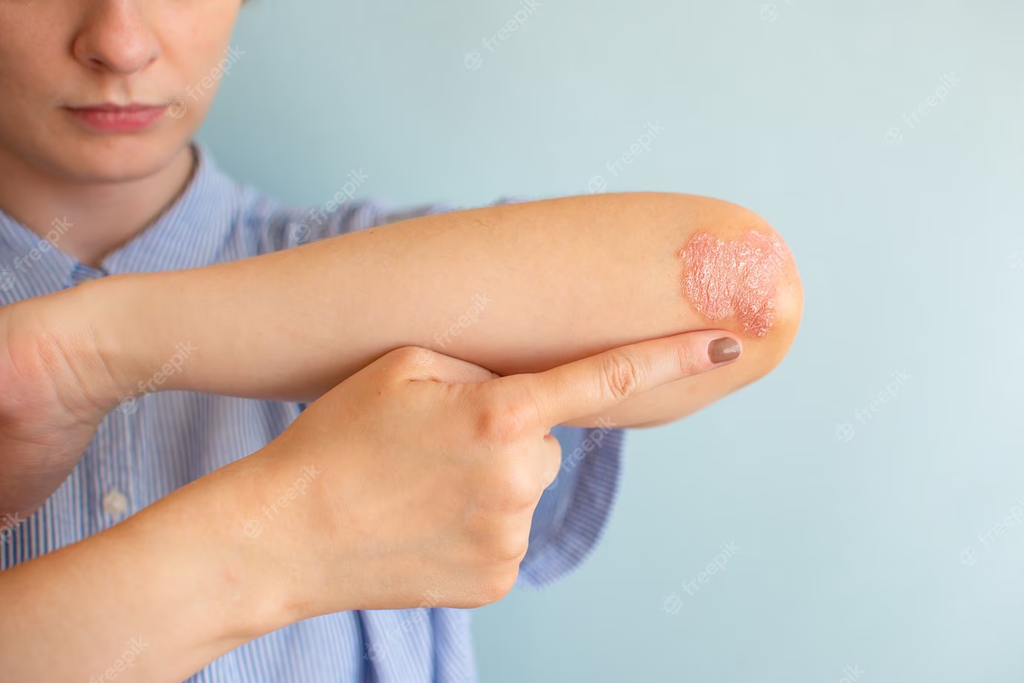 Psoriasis vs Ringworm: What's the Difference and How to Tell Them Apart?