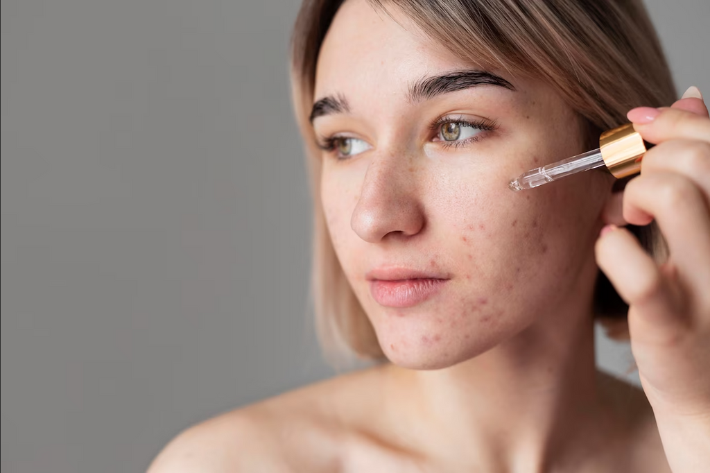 Unlock the Secrets to Acne Scar Treatment: Comprehensive Guide on Preventing Acne Scars