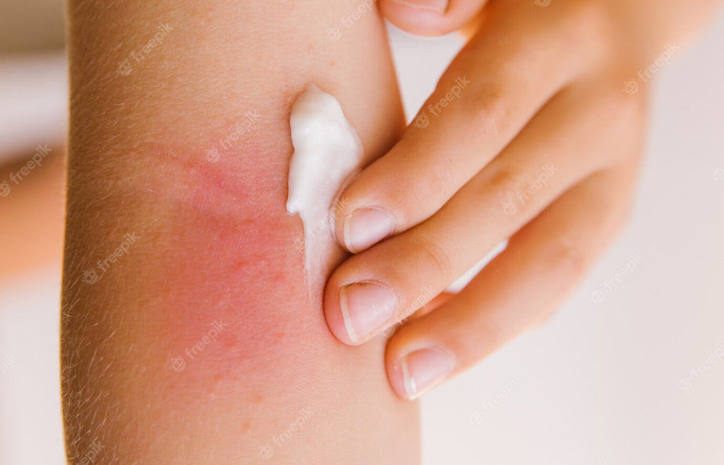 The Comprehensive Guide to Understanding Rash: Definition, Causes, and Treatment
