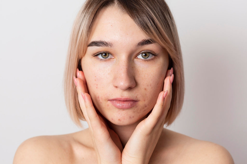 Uncovering the Benefits of Biotin for Acne Prone Skin