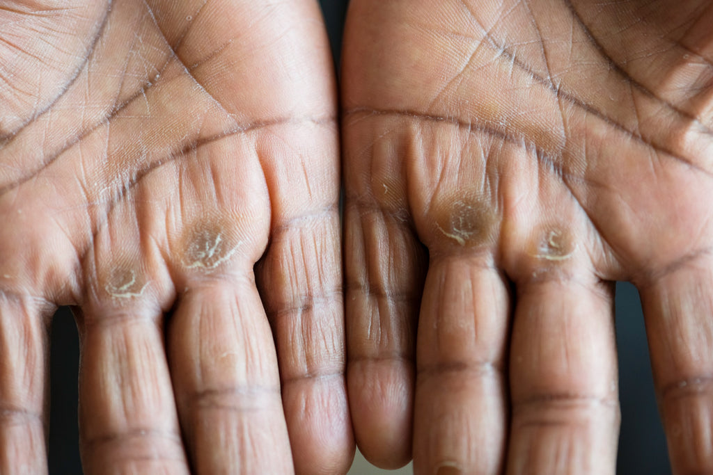 The Truth About Calluses: Are They Actually Good for Your Skin?
