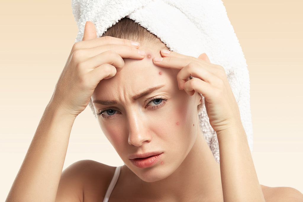 How to Get Rid of Acne on Forehead: Expert Tips for Clearer Skin