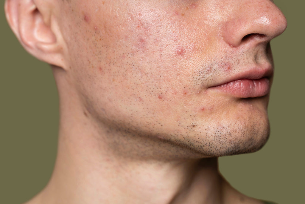 How Does Propionibacterium Cause Acne in Humans?