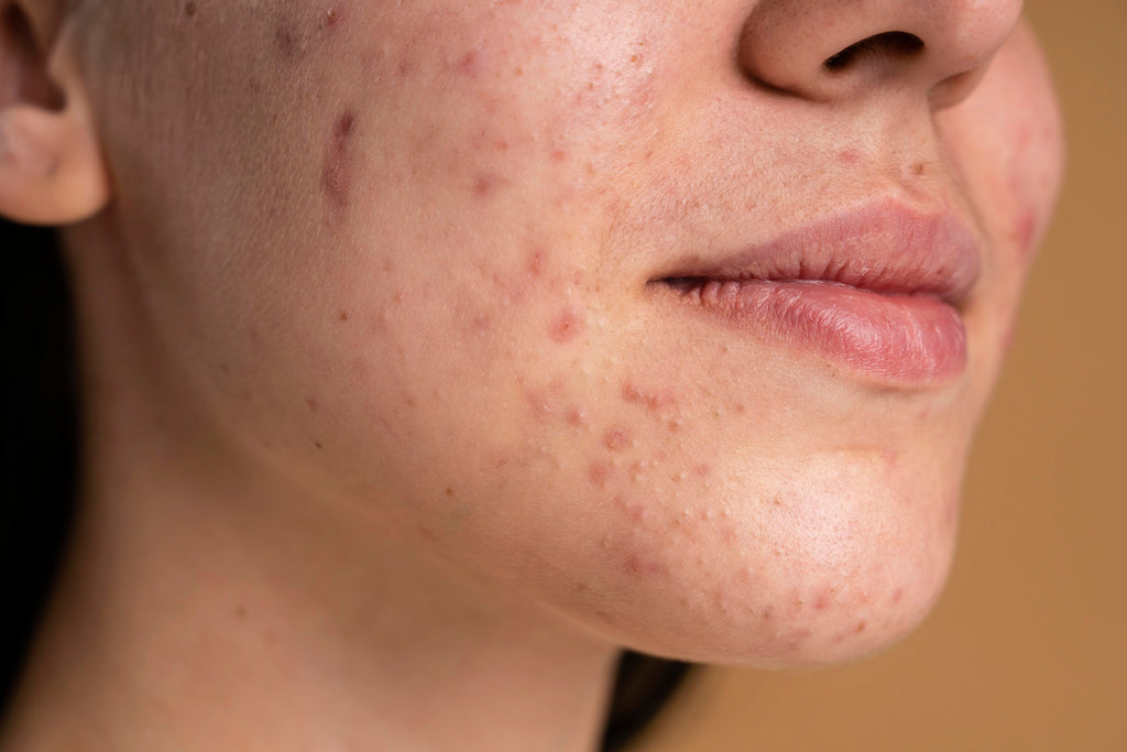 How to Get Rid of Fungal Acne Effectively