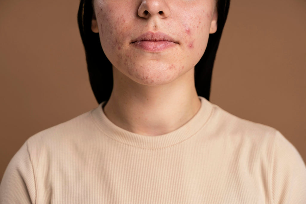 Effective Strategies for Managing Cystic Acne