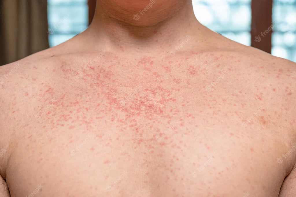 Unveiling the Mystery: Decoding the Rash That Looks Like Shingles