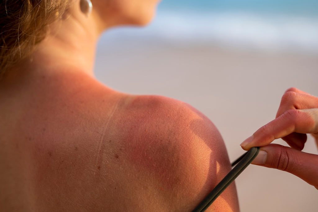 From Redness to Peeling: Navigating the Stages of Sunburn