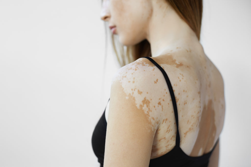 Say Goodbye to Eczema Discoloration: A Comprehensive Guide