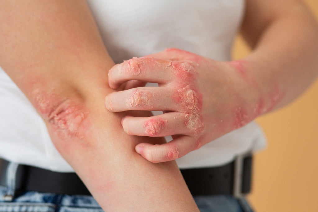 Understanding the Four Stages of Psoriasis Healing: A Comprehensive Guide to Effective Treatment