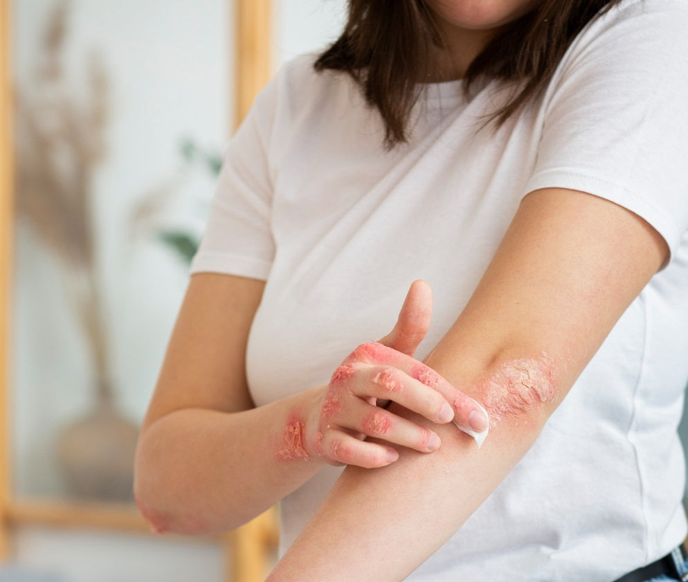 Effective Home Remedies for Seborrheic Dermatitis: Say Hello to Healthy Skin