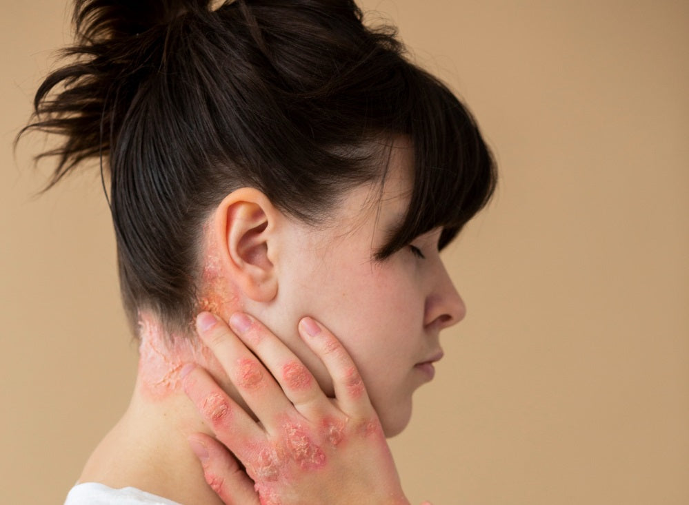 Understanding Seborrheic Dermatitis Ear: Causes, Symptoms, and Treatment Options