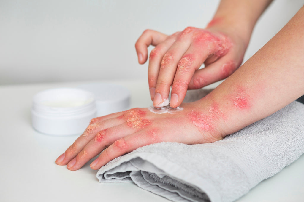 Say Goodbye to Nummular Eczema: Expert Tips on Treatment and Prevention
