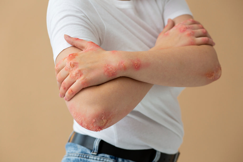 Say Goodbye to Eczema Scars: The Ultimate Guide on How to Get Rid of Them