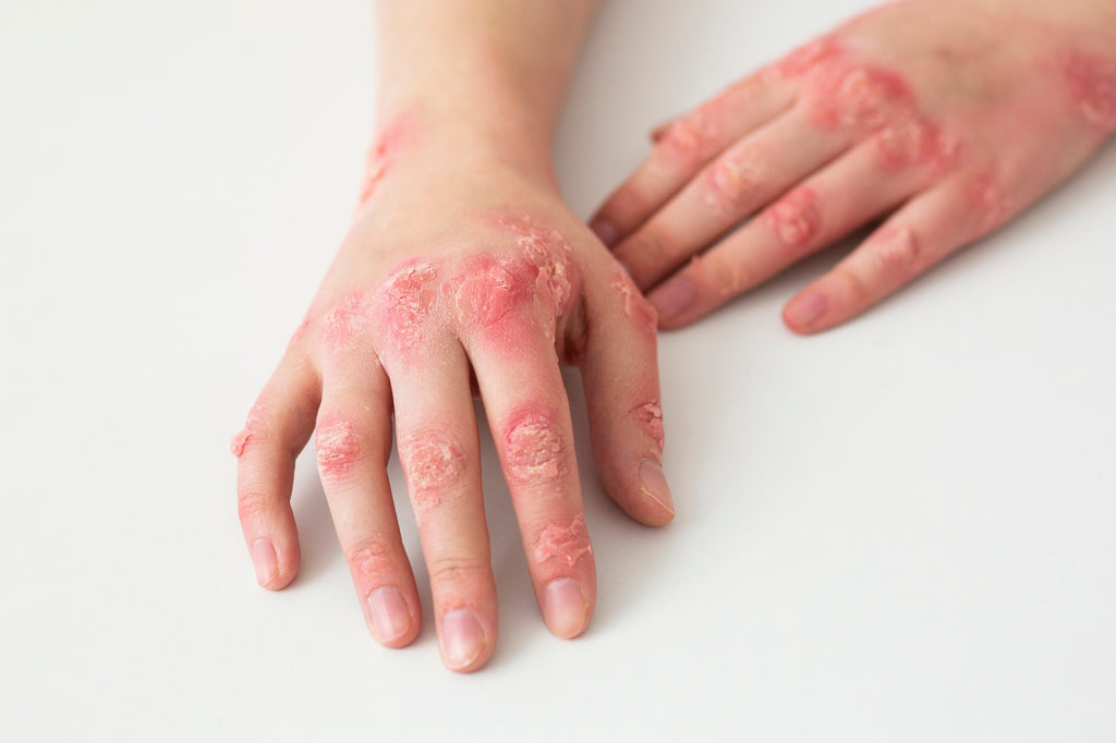 Understanding Psoriasis Hands: Symptoms, Causes and Treatment Options
