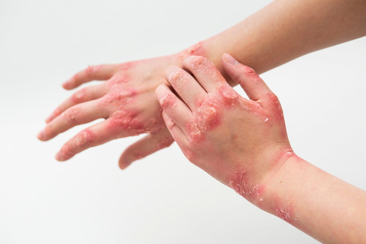 Understanding Psoriasis on Hands: Causes, Symptoms, and Effective Trea ...