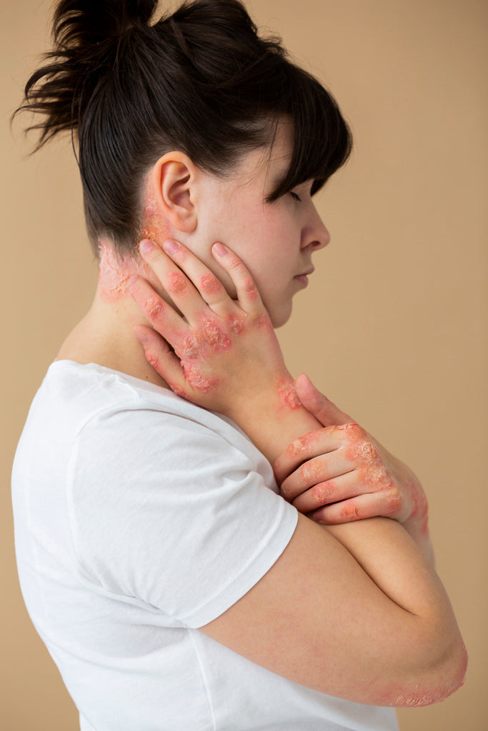 Effective Atopic Dermatitis Treatments for Treating Eczema on the Neck, Face and Scalp