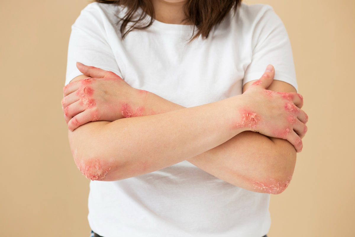 Understanding the Key Differences: Psoriasis vs Seborrheic Dermatitis ...