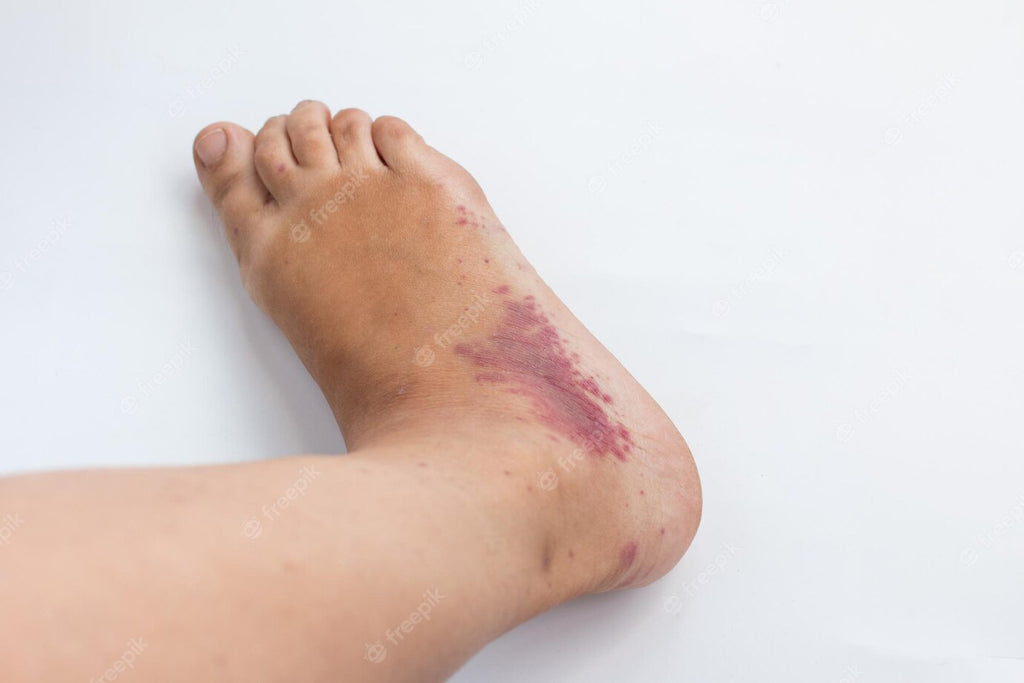 Dealing with a Rash on the Top of Your Foot: Expert Tips and Advice for Relief
