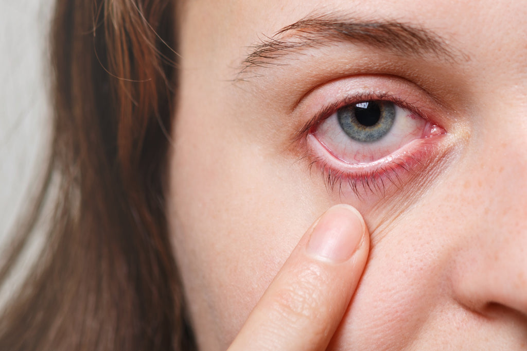 Clearing Your Vision: A Comprehensive Guide to Ocular Rosacea Treatment