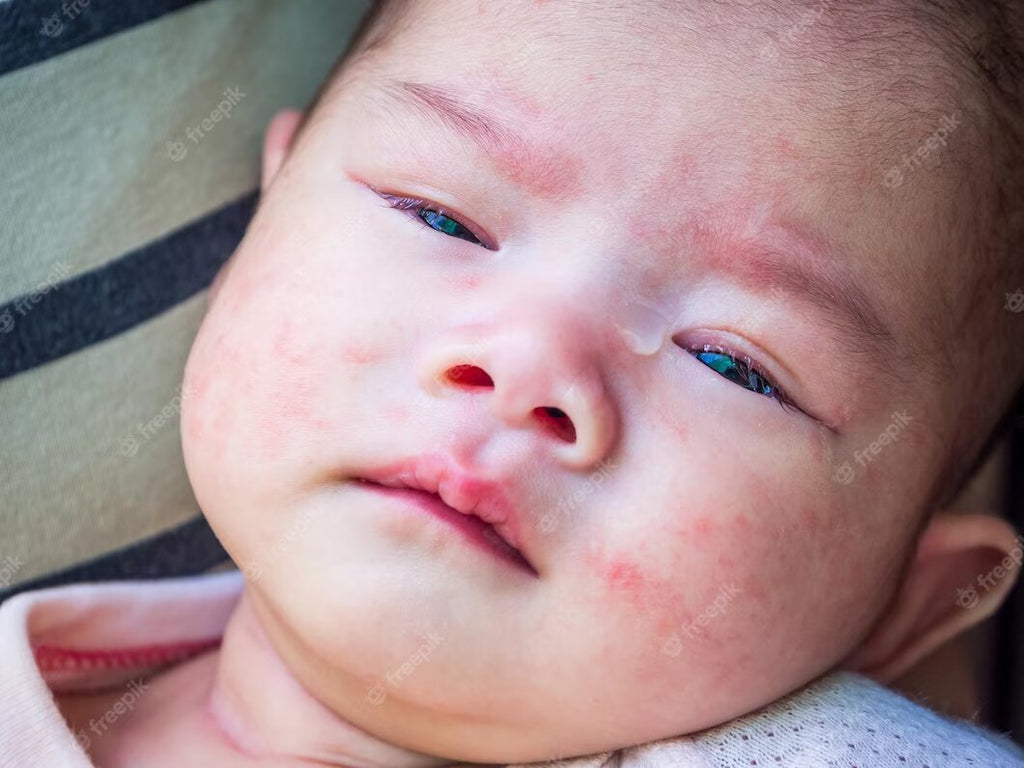 The Ultimate Guide to Treating Seborrheic Dermatitis on Your Newborn's Face
