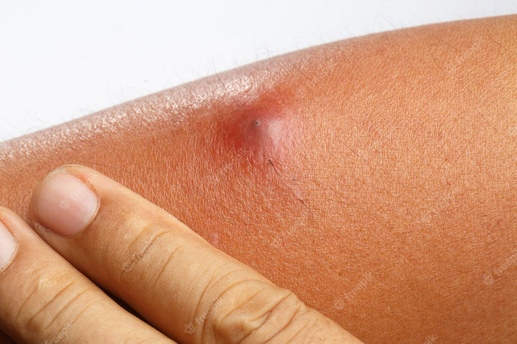 Understanding the Causes and Treatments for Red Bumps on the Skin