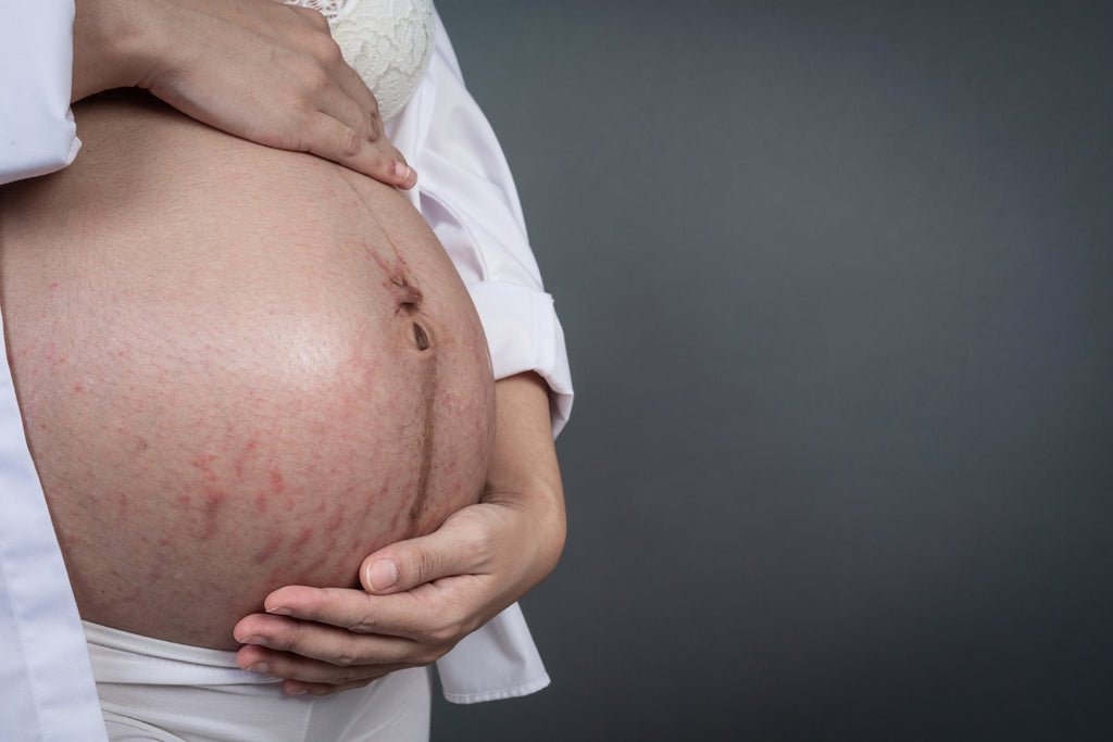 The Journey to Clear Skin: When Does Pregnancy Acne Fade Away?