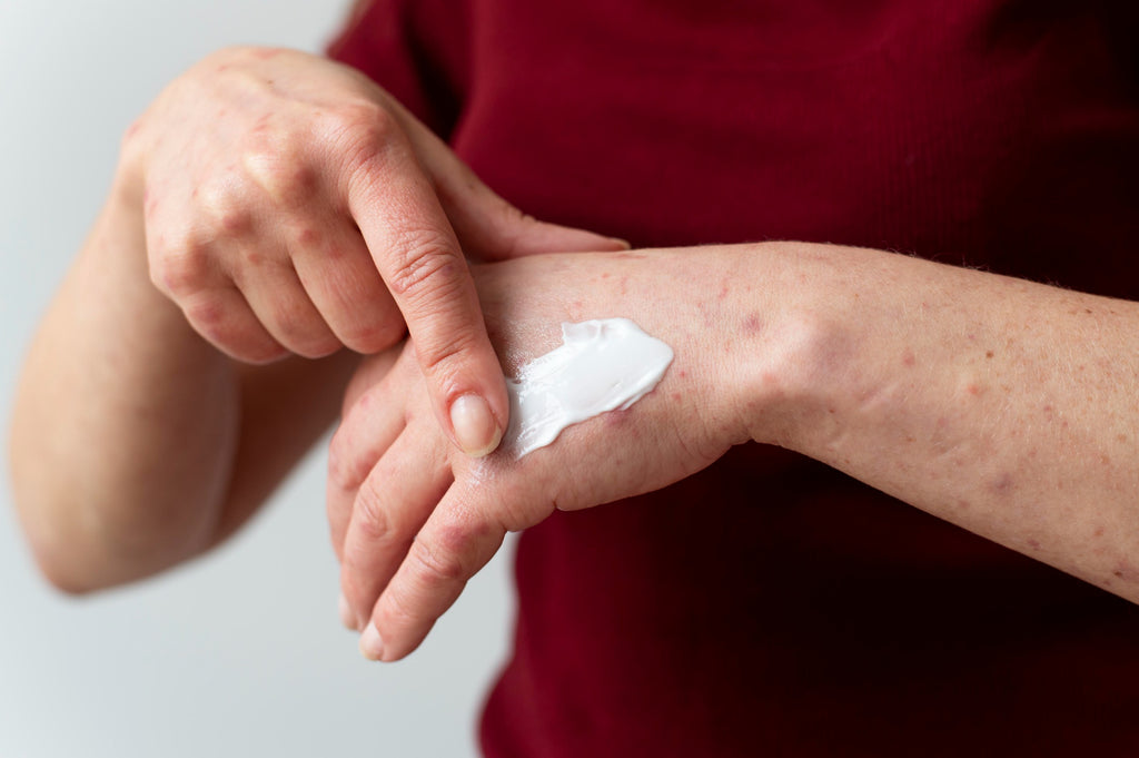 The Science Behind Why Eczema Burns with Cream Application