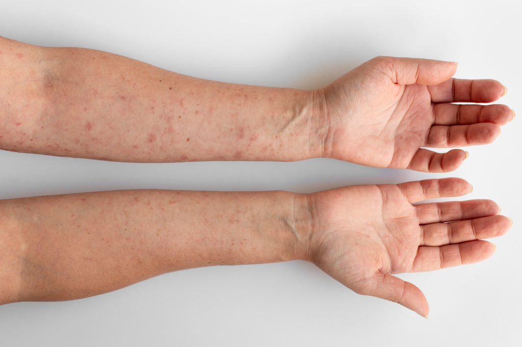 Seborrheic Dermatitis vs. Psoriasis: Understanding the Differences for Effective Treatment