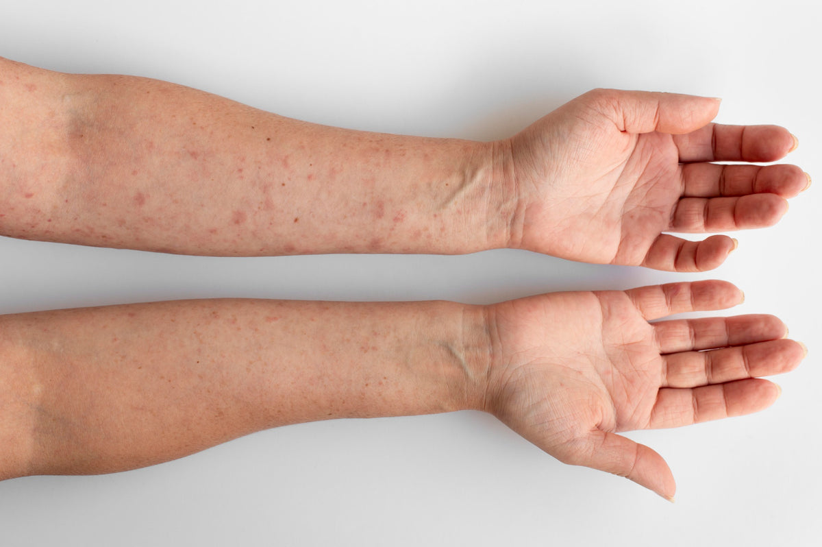 Seborrheic Dermatitis Vs Psoriasis Understanding The Differences For Purclarity Skincare