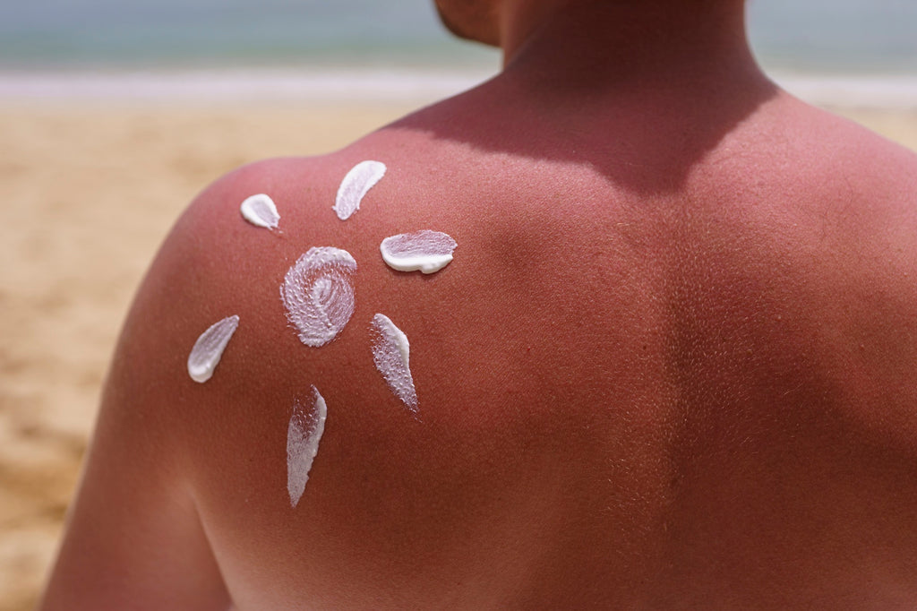The Ultimate Guide to Sunburn Itch Relief: Natural and Dermatologist-Recommended Solutions