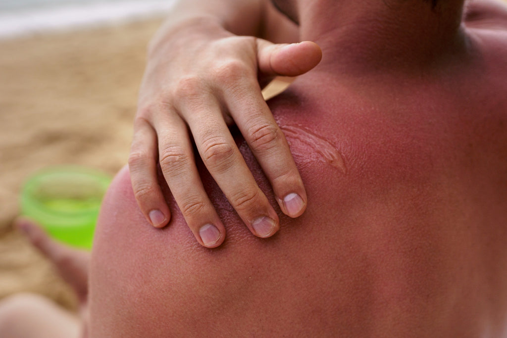 Relief at Last: How to Soothe and Alleviate Sunburn Itches