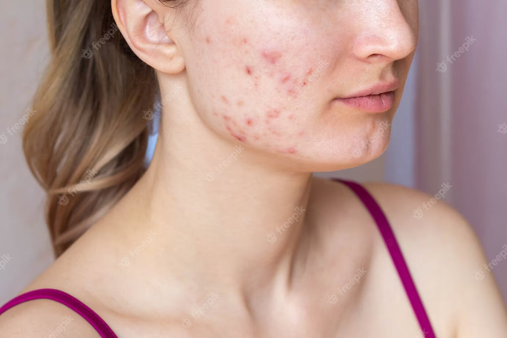 Say Goodbye to Redness: Expert Tips on How to Get Rid of Acne Redness