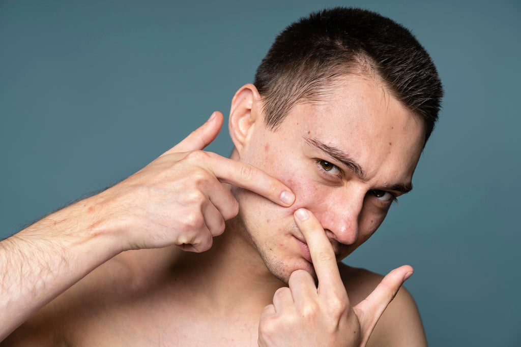 Unraveling the Mystery: Why Does Acne Itch? Exploring the Connection Between Itchy Acne and Skin Health