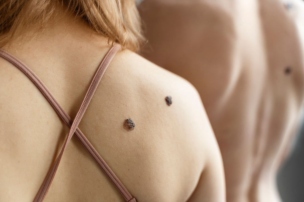 Say Goodbye to Skin Tags: A Step-by-Step Guide on How to Remove Skin Tags in One Night